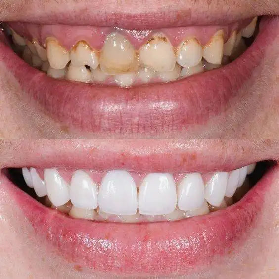 CARRILLA DENTALES