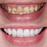 CARRILLA DENTALES